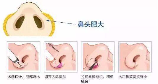 鼻尖肥大過厚怎麽改善?做鼻尖手術時這幾點一定要注意!