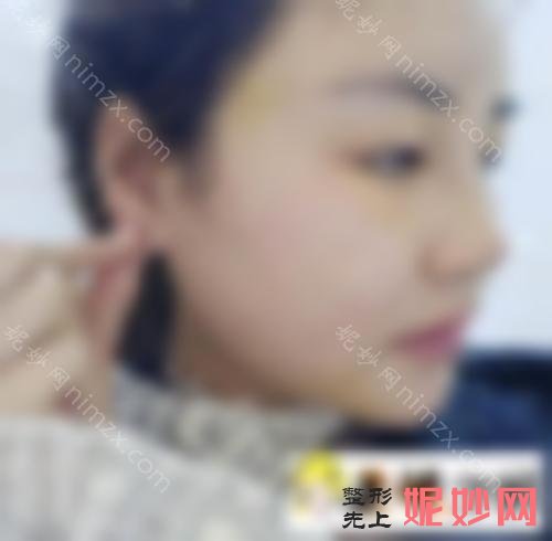 成都趙善軍（jun1）博士怎麽樣？小妹妹做（zuò）麵部抽脂兩年後（hòu）沒有反彈！