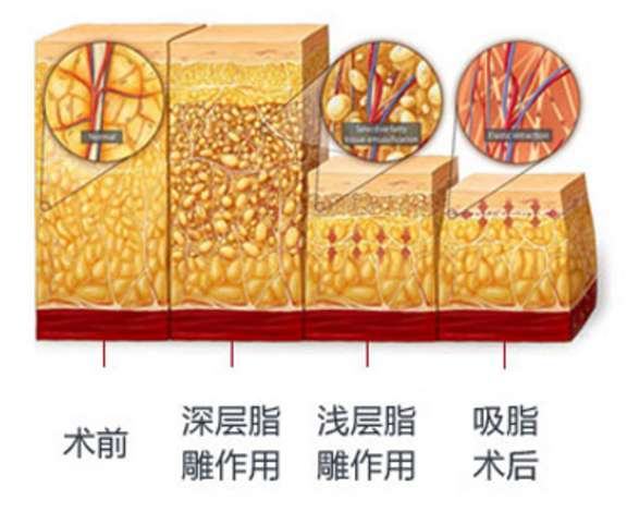 沈陽杏林整容醫院：突破傳統，重新定義吸脂技術